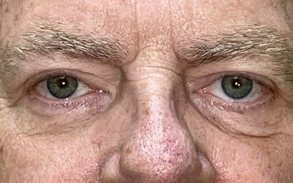 Eyelid Lift (Blepharoplasty/Ptosis Repair)