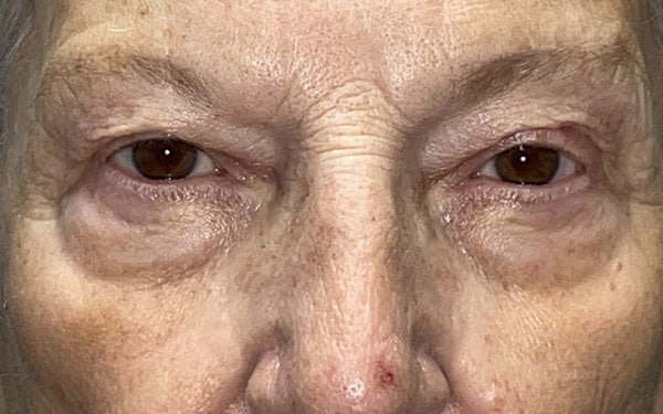 Eyelid Lift (Blepharoplasty/Ptosis Repair)