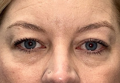 Upper/Lower Lid Blepharoplasty