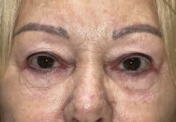 Upper/Lower Lid Blepharoplasty