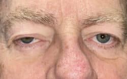 Eyelid Lift (Blepharoplasty/Ptosis Repair)