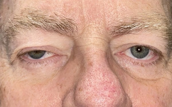Eyelid Lift (Blepharoplasty/Ptosis Repair)