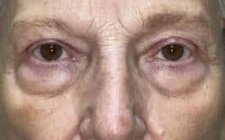 Eyelid Lift (Blepharoplasty/Ptosis Repair)