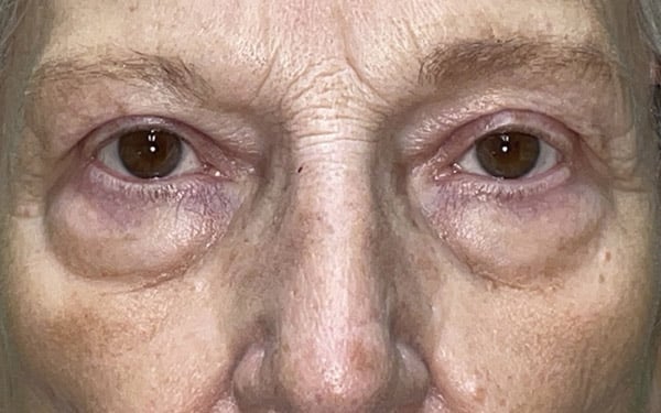 Eyelid Lift (Blepharoplasty/Ptosis Repair)