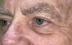 Eyelid Lift (Blepharoplasty/Ptosis Repair)
