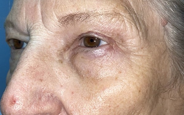 Eyelid Lift (Blepharoplasty/Ptosis Repair)