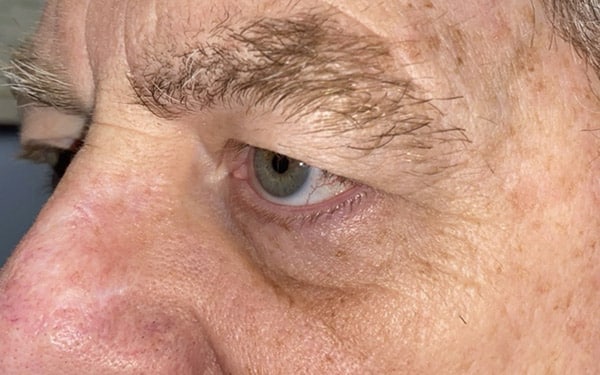 Eyelid Lift (Blepharoplasty/Ptosis Repair)