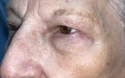 Eyelid Lift (Blepharoplasty/Ptosis Repair)