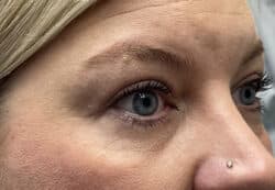 Upper/Lower Lid Blepharoplasty