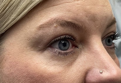 Upper/Lower Lid Blepharoplasty