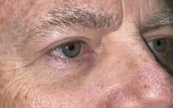 Eyelid Lift (Blepharoplasty/Ptosis Repair)