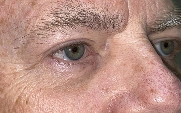 Eyelid Lift (Blepharoplasty/Ptosis Repair)
