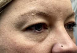 Upper/Lower Lid Blepharoplasty