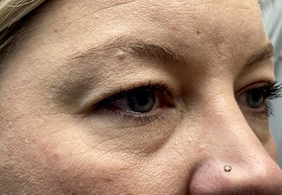 Upper/Lower Lid Blepharoplasty
