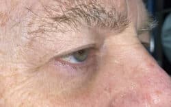 Eyelid Lift (Blepharoplasty/Ptosis Repair)
