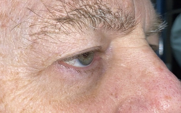 Eyelid Lift (Blepharoplasty/Ptosis Repair)