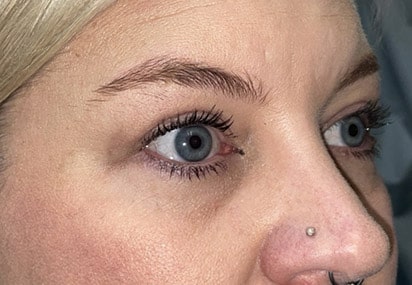 Upper/Lower Lid Blepharoplasty