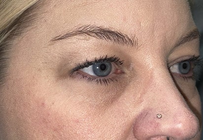 Upper/Lower Lid Blepharoplasty