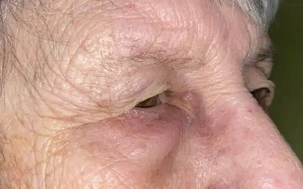 Eyelid Lift (Blepharoplasty/Ptosis Repair)
