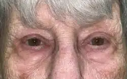 Eyelid Lift (Blepharoplasty/Ptosis Repair)