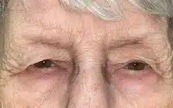Eyelid Lift (Blepharoplasty/Ptosis Repair)