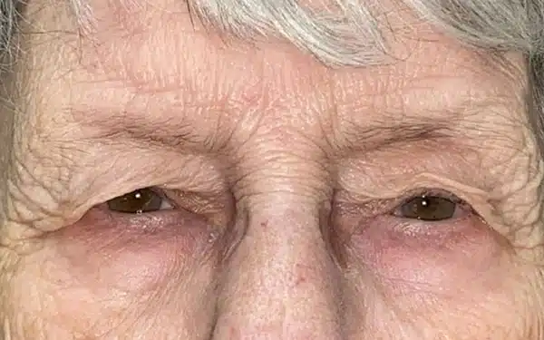 Eyelid Lift (Blepharoplasty/Ptosis Repair)