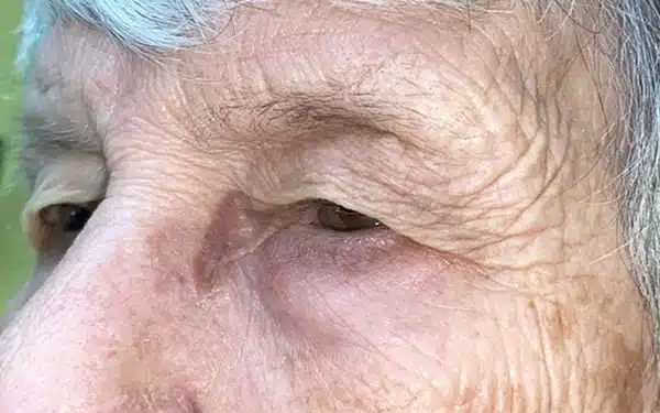Eyelid Lift (Blepharoplasty/Ptosis Repair)