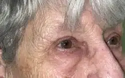 Eyelid Lift (Blepharoplasty/Ptosis Repair)