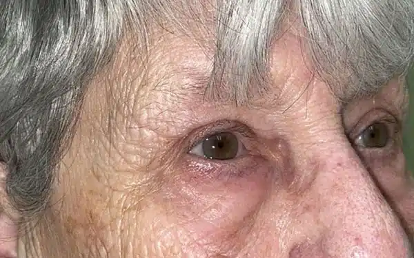 Eyelid Lift (Blepharoplasty/Ptosis Repair)