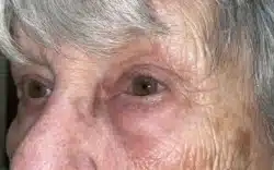 Eyelid Lift (Blepharoplasty/Ptosis Repair)
