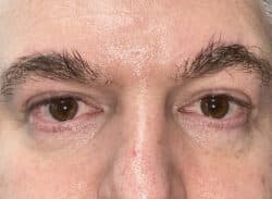 Combination Surgeries (eyelid lift and other)