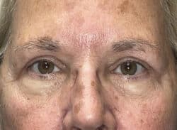 Combination Surgeries (eyelid lift and other)