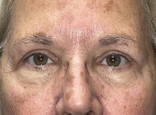 Combination Surgeries (eyelid lift and other)