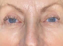 Combination Surgeries (eyelid lift and other)