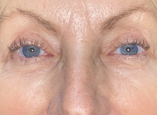 Combination Surgeries (eyelid lift and other)