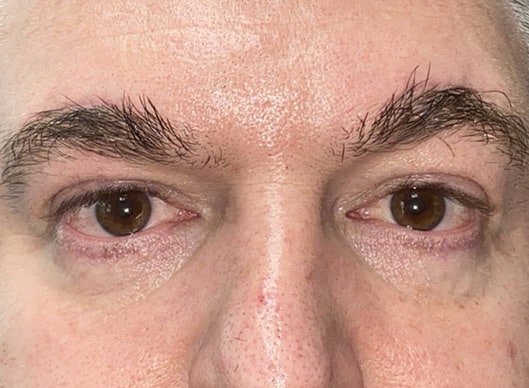 Combination Surgeries (eyelid lift and other)
