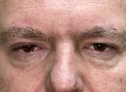 Combination Surgeries (eyelid lift and other)