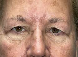 Combination Surgeries (eyelid lift and other)