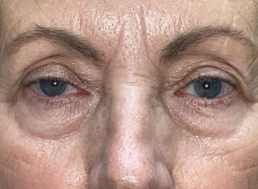 Combination Surgeries (eyelid lift and other)