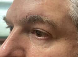 Combination Surgeries (eyelid lift and other)