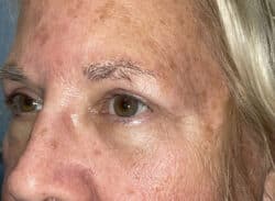 Combination Surgeries (eyelid lift and other)