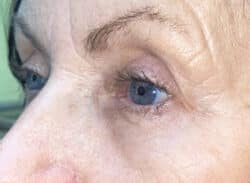 Combination Surgeries (eyelid lift and other)