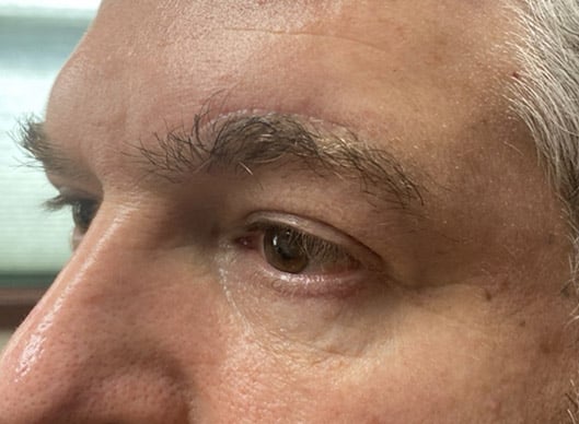 Combination Surgeries (eyelid lift and other)