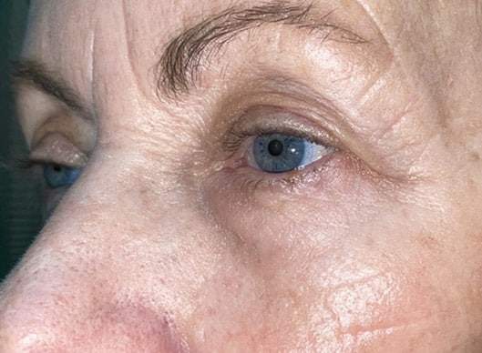 Combination Surgeries (eyelid lift and other)