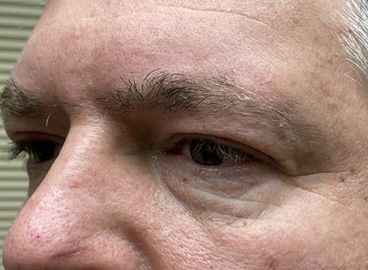 Combination Surgeries (eyelid lift and other)