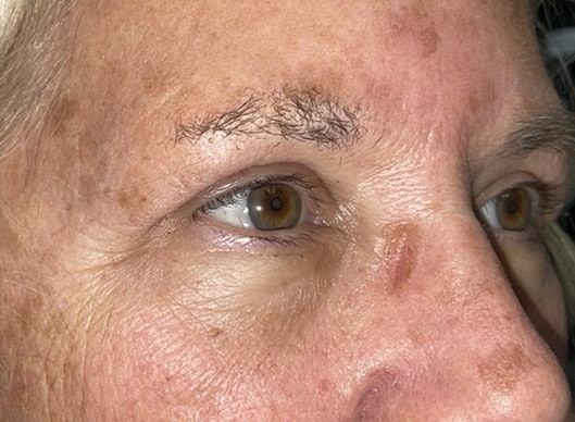 Combination Surgeries (eyelid lift and other)