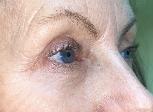 Combination Surgeries (eyelid lift and other)