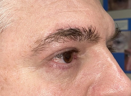 Combination Surgeries (eyelid lift and other)