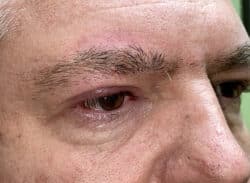 Combination Surgeries (eyelid lift and other)