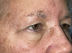 Combination Surgeries (eyelid lift and other)